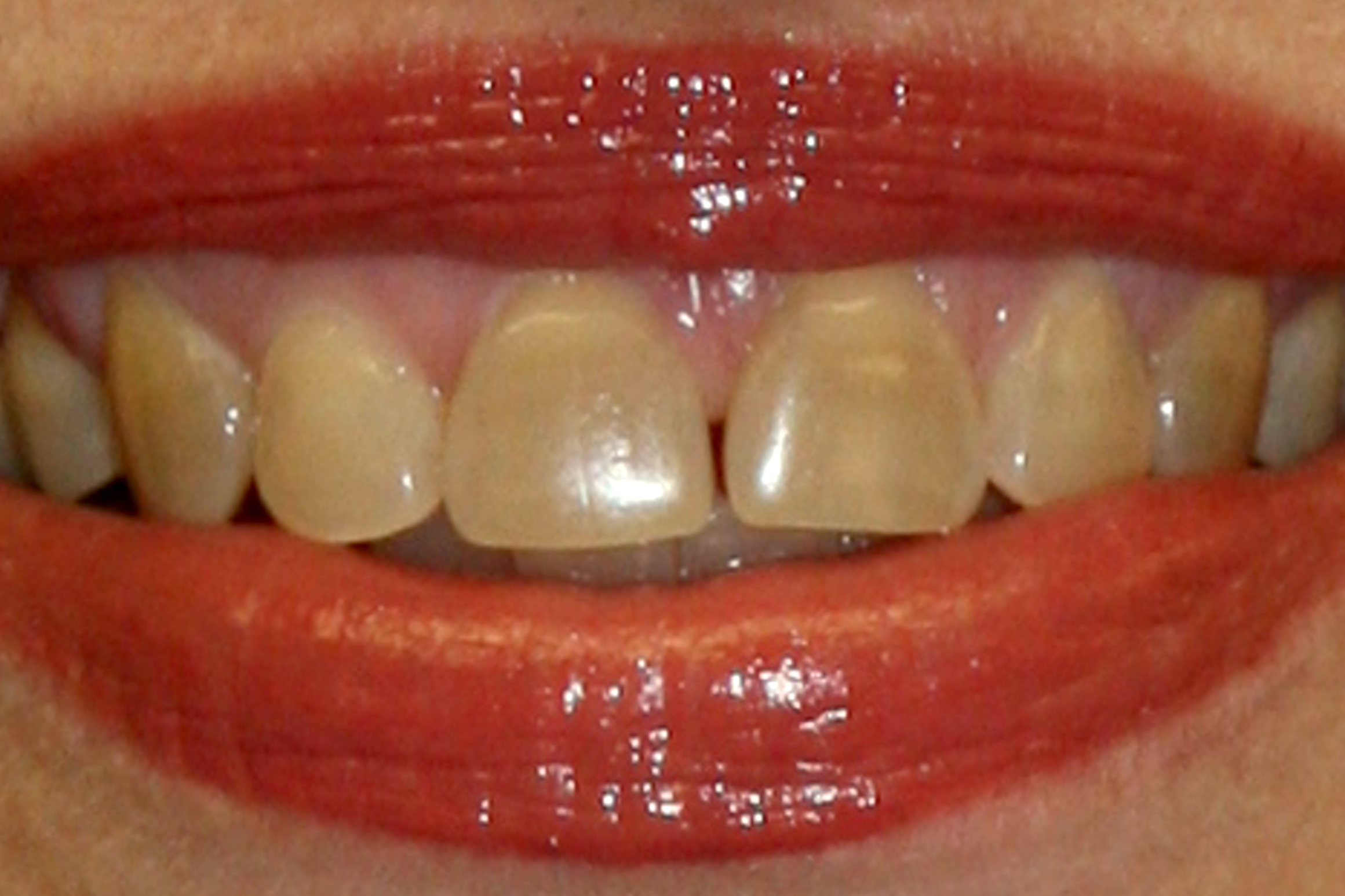 163BEFORE + • KöR Whitening