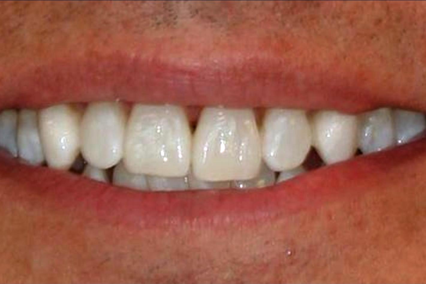 40AFTER + • KöR Whitening