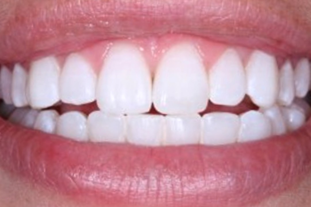 45AFTER + • KöR Whitening