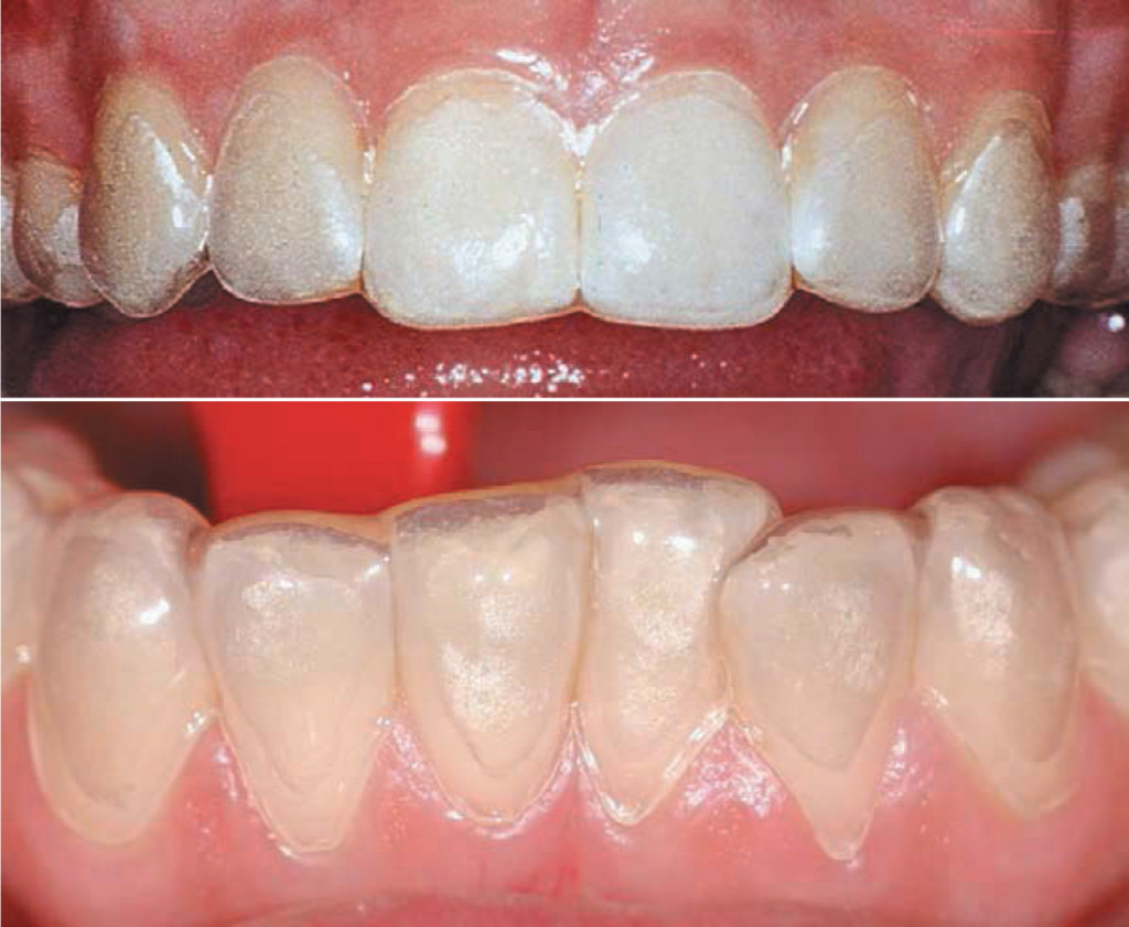 KoR-Seal Trays_upper-lower • KöR Whitening