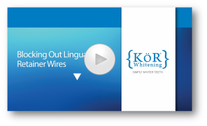 Blocking Out Lingual Retainer Wires Video